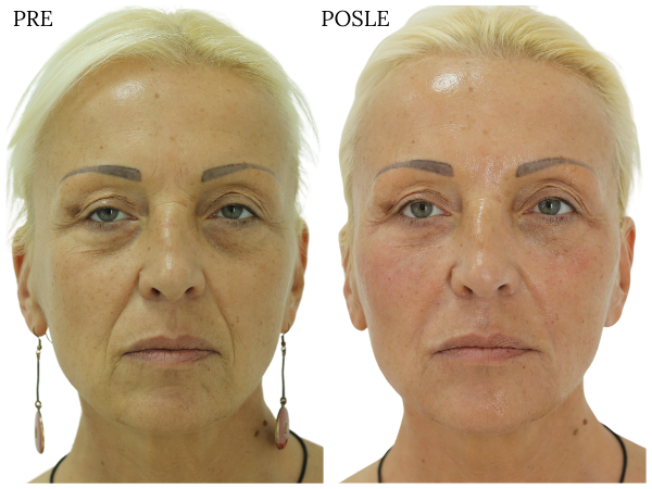 podmlađivanje hijaluronski fileri