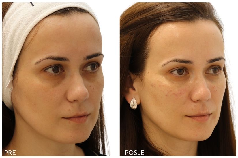 pre i posle hijaluronski fileri
