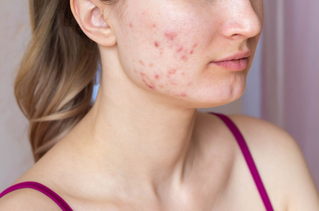 akne lečenje