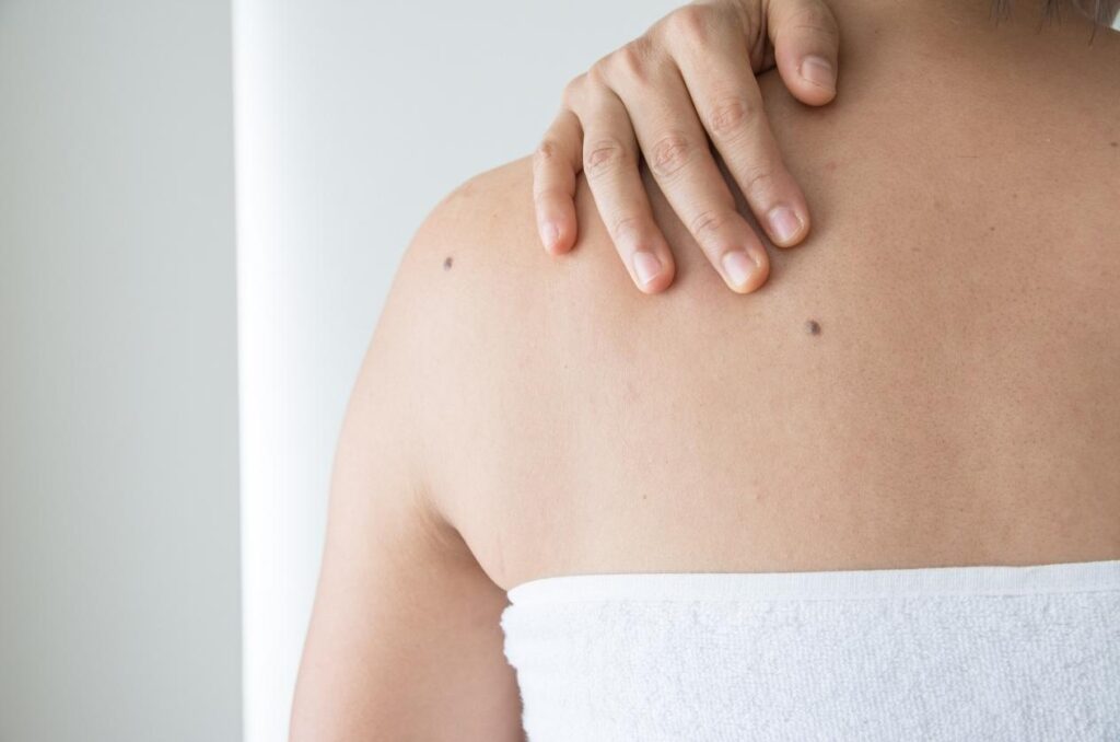 bradavice uklanjanje