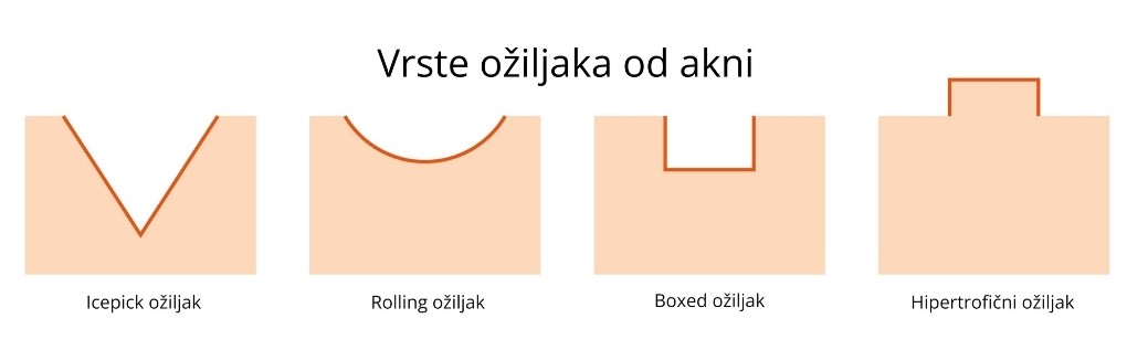 ožiljci od akni vrste