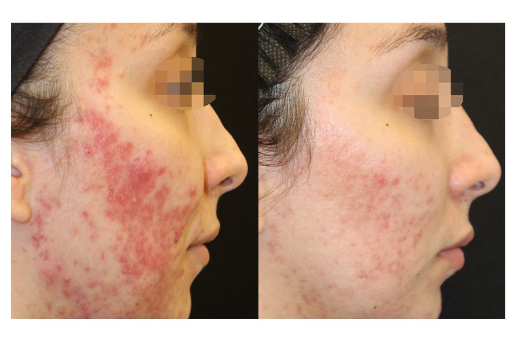 harmony xl pro pre i posle 1 rozacea