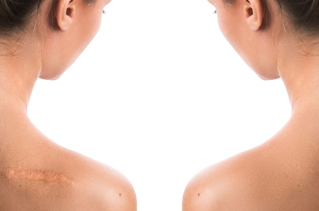 keloidi i hipertrofični ožiljci