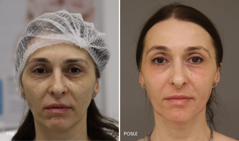 pre i posle hijaluronski fileri
