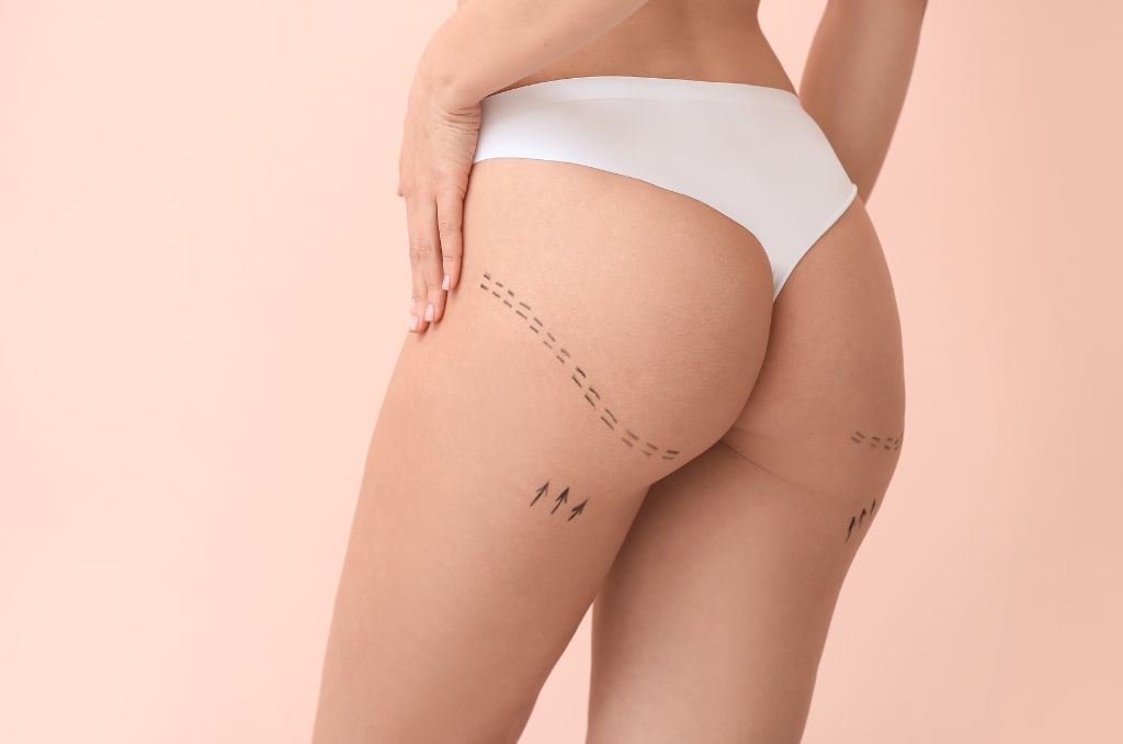 podizanje zadnjice tretman