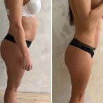 Kako ukloniti lokalizovane masne naslage