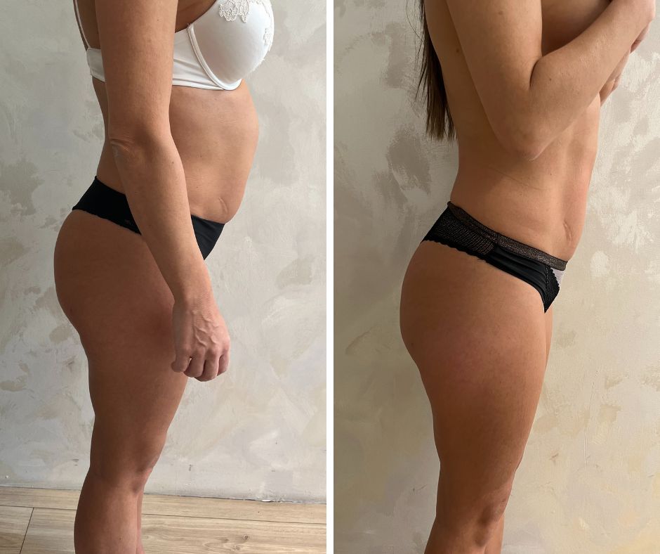 Kako ukloniti lokalizovane masne naslage