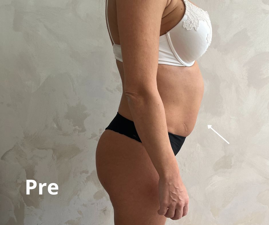 pre tretmana alma primex