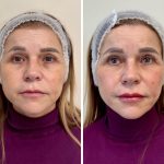 Podmlađivanje filerima pre i posle