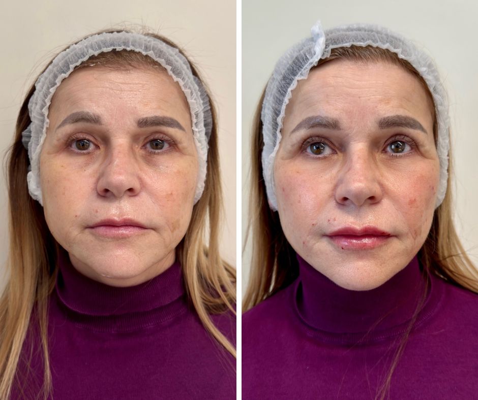 Podmlađivanje filerima pre i posle