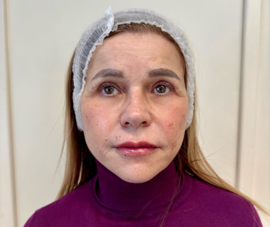 Podmlađivanje filerima