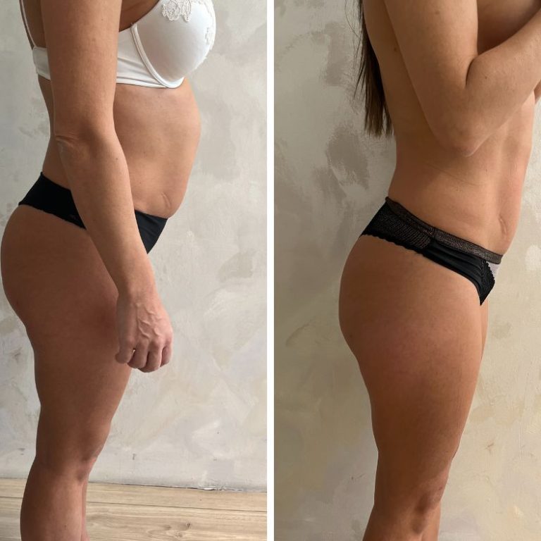 Kako ukloniti lokalizovane masne naslage